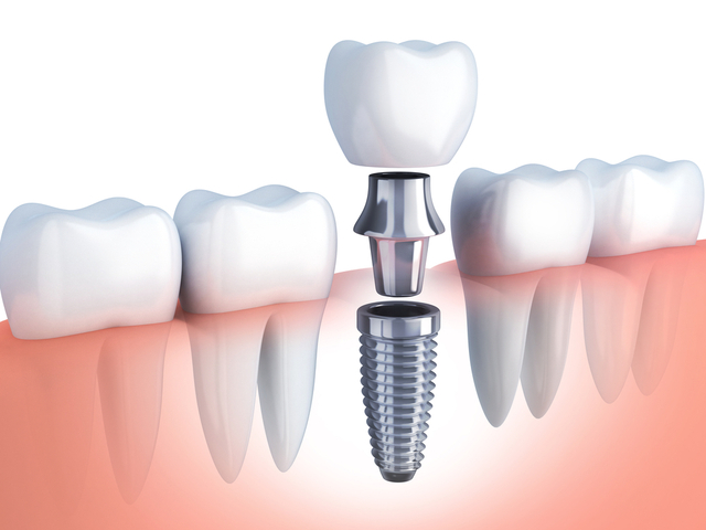 The Benefits of Dental Implants